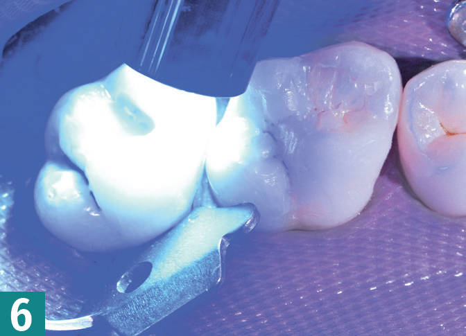 Реставрация DMG Constic - этап 6